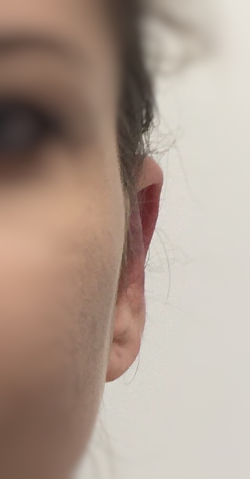 R&eacute;sultat apr&egrave;s otoplastie EarFold - Dr Mahdyoun